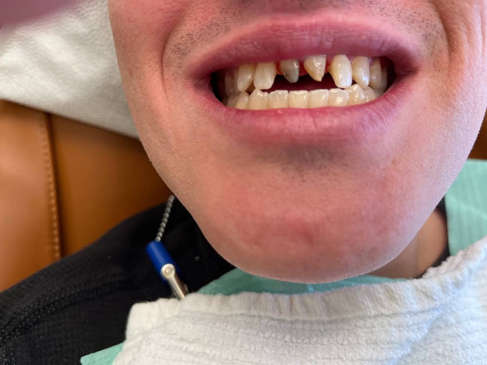 Metal Crowns Cost Toronto | Before